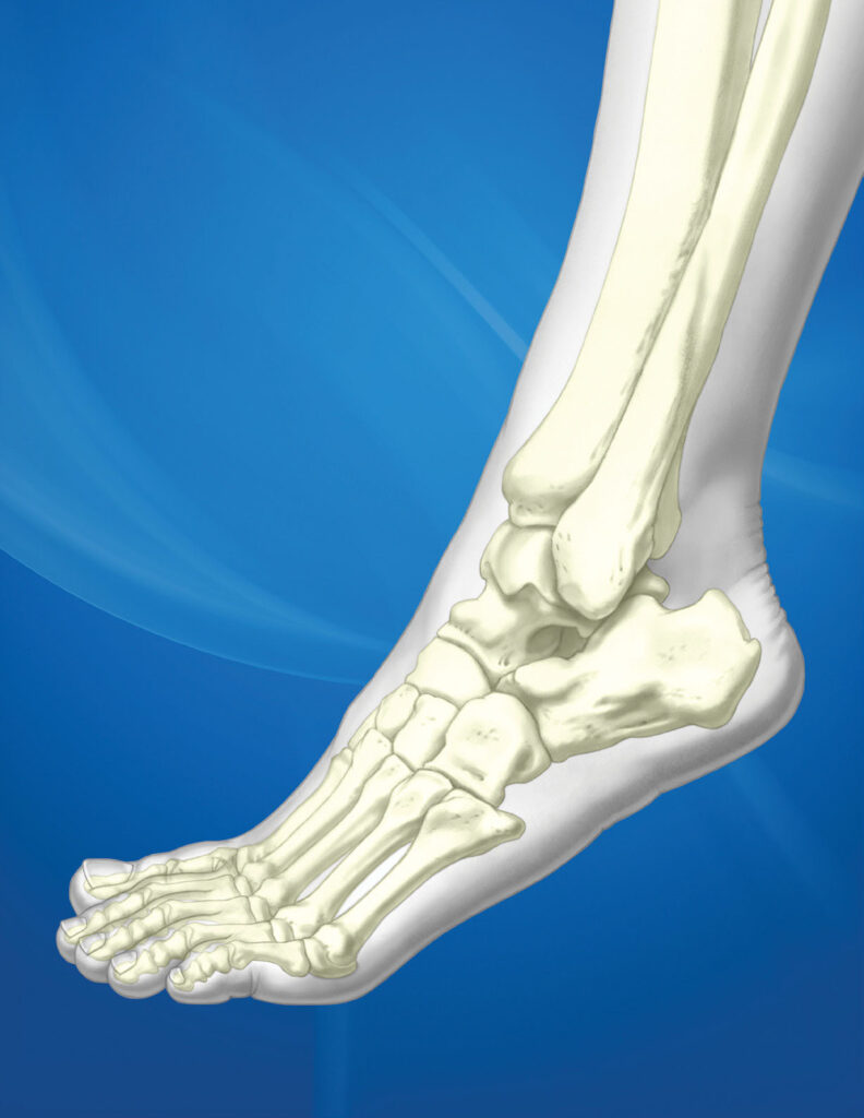 ASET Foot Plating System: Hooks – Ortho Providers